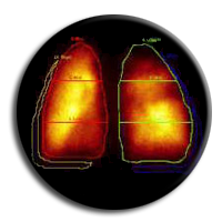 Scintigraphie Pulmonaire